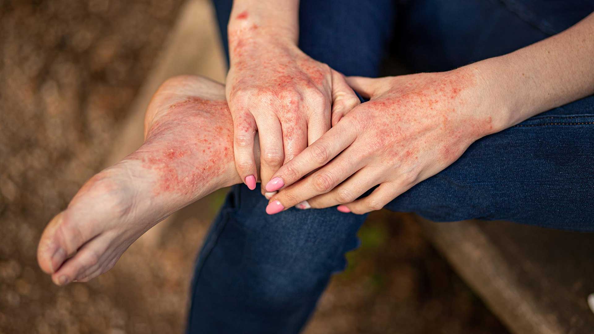 Personalised Hypnosis Audio for Eczema