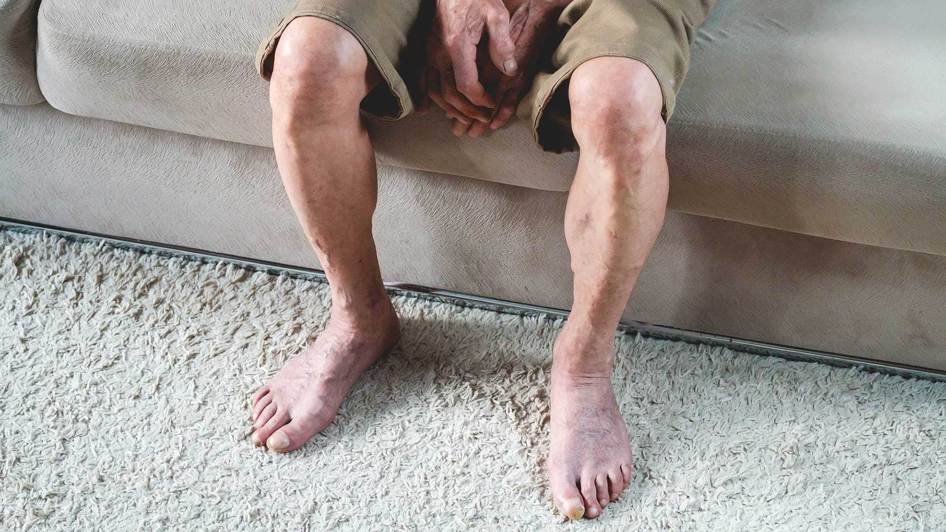 Background image for Restless Leg Syndrome Hypnotherapy