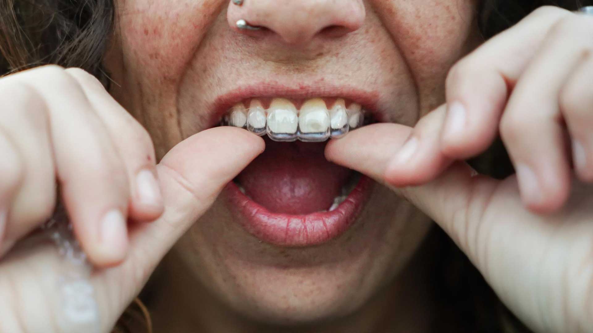 Background image for Teeth Grinding (Bruxism) Hypnotherapy